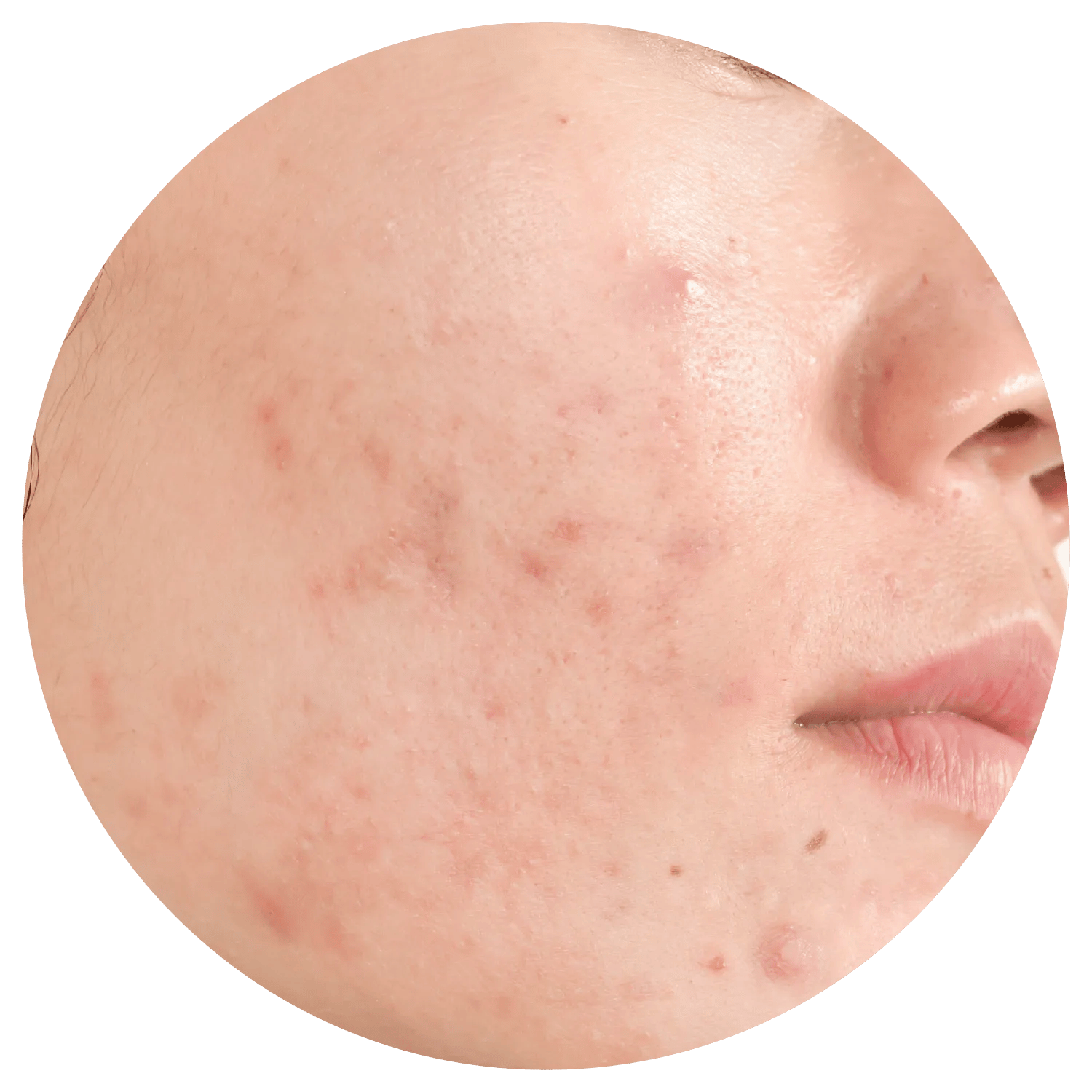Active Acne treatment process at Toronto medical spa - Understand the deeper causes of acne.